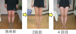 愛知県江南市のO脚矯正 施術効果