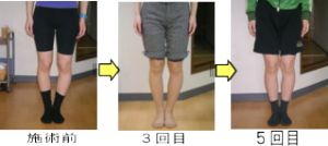 健康快復センター江南のO脚矯正の効果