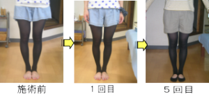 愛知県江南市のO脚矯正の効果