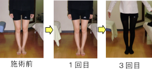 健康快復センター江南のO脚矯正 Before & After